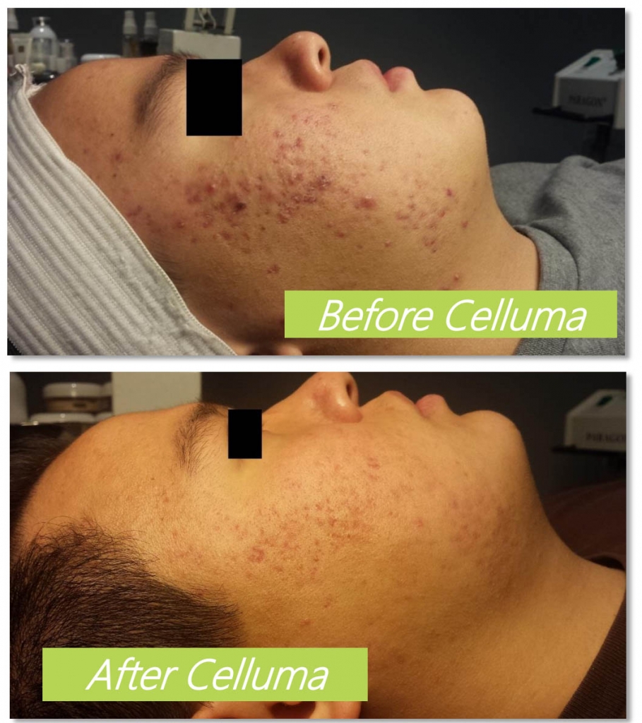 Celluma LED BioPhotas Acne Care and AntiAging Bend Oregon